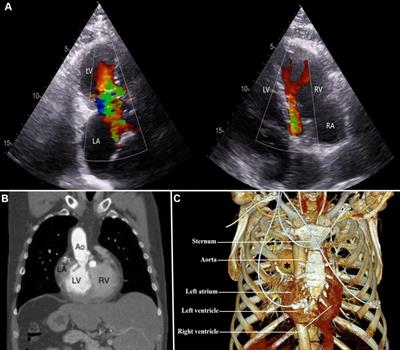 Case report: Video-assisted minimally invasive mitral and pulmonary valve replacement as reoperation in patient with situs inversus totalis